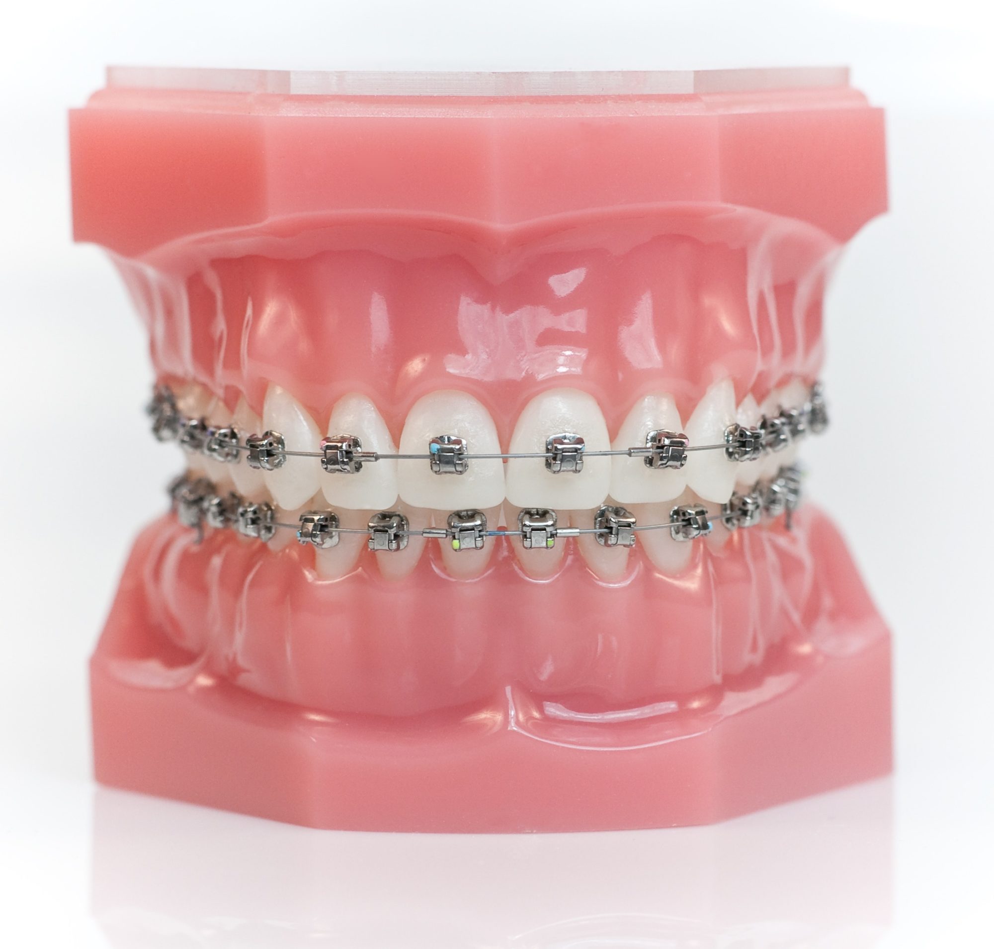 Best orthodontist patient getting braces in Bridgeton.